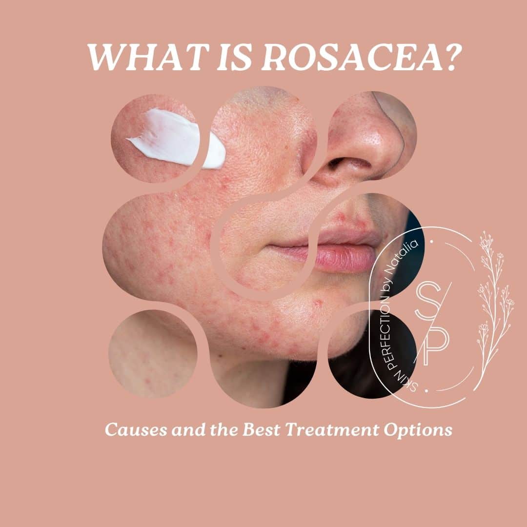 What is Rosacea?
